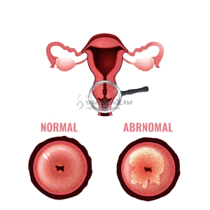 hpv kesin tedavisi bulundu