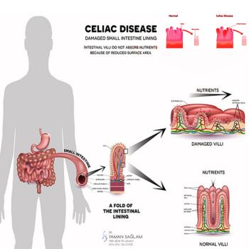 Çölyak hastası olabilirim, nasıl anlayabilirim? En iyi teşhis nerede konulur?