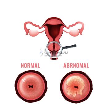 hpv tiplendirmesi nedir